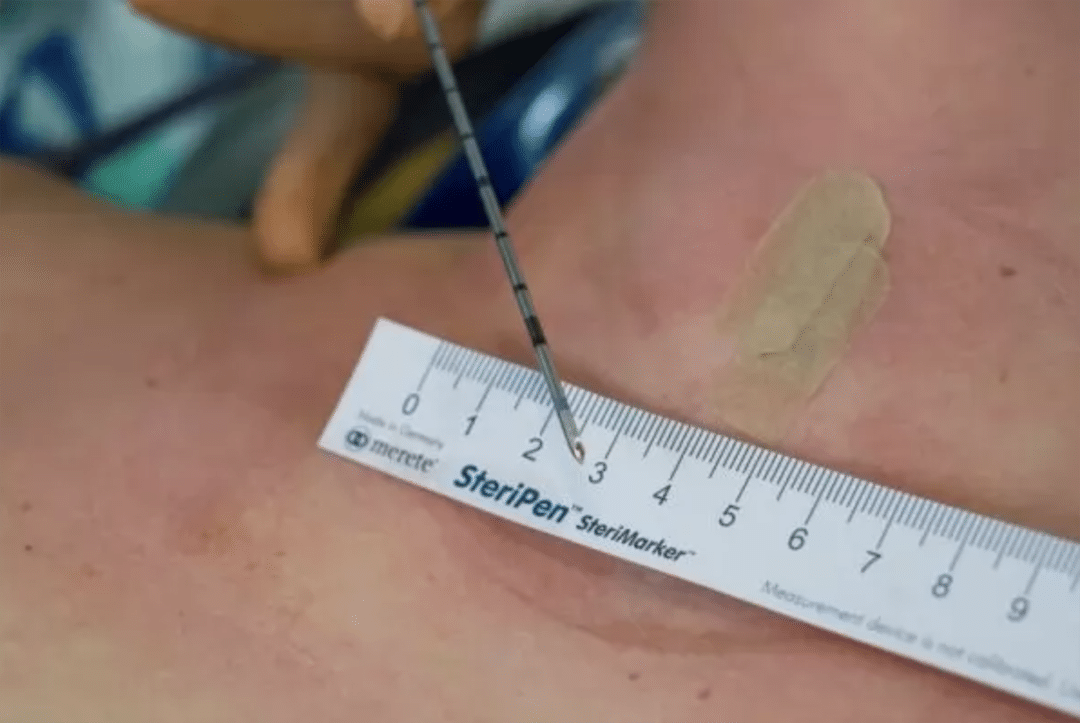 Deutsches Schilddruesenzentrum, Wissenswertes Behandlung Thermoablation 3