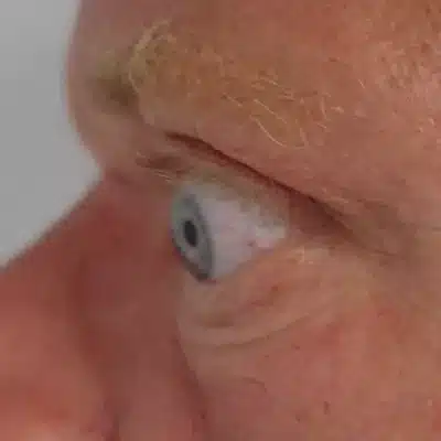 Aktuelle Studie: Augentropfen bei trockenen Basedow-Augen
